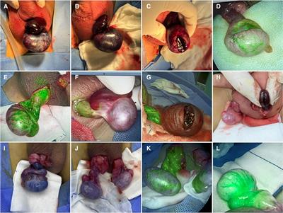 Evaluation of testicular blood flow during testicular torsion surgery in children using the indocyanine green–guided near-infrared fluorescence imaging technique